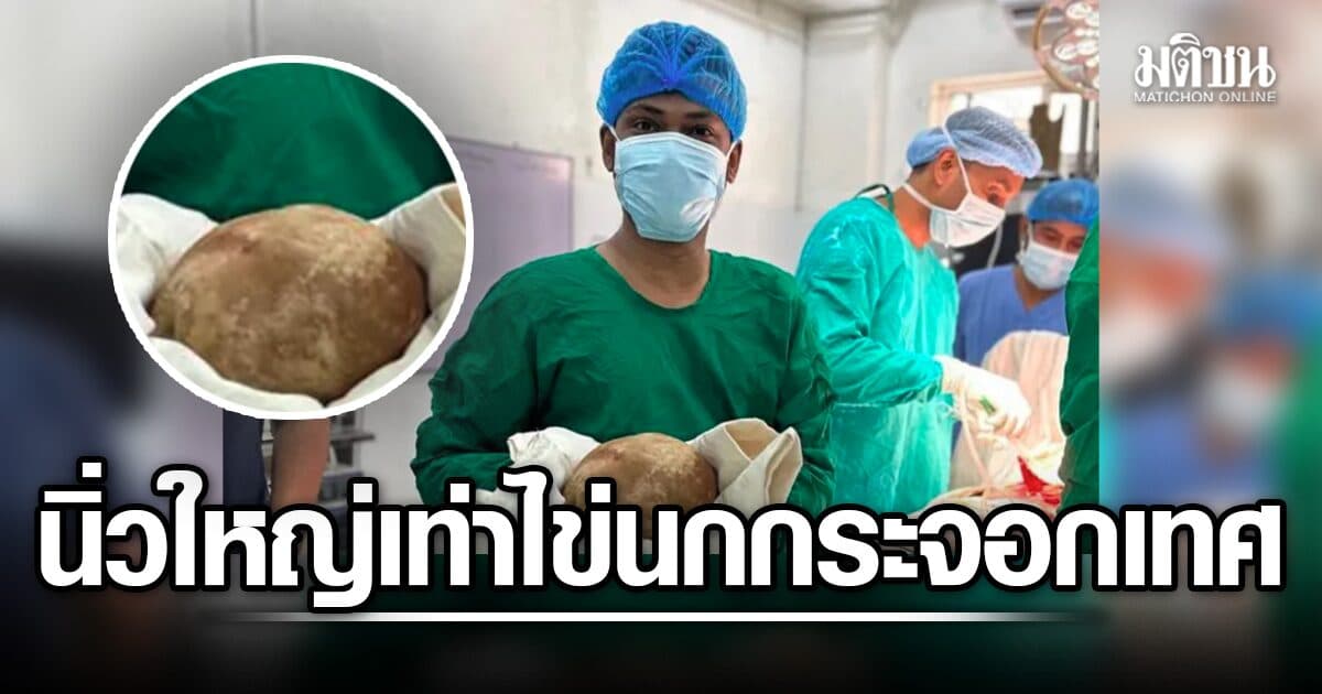 ตะลึง! หมอศรีลังกา ผ่าตัดก้อนนิ่วมหึมา หนัก 3.1 กก. ในกระเพาะปัสสาวะคนไข้ เชื่อใหญ่สุดเท่าที่เคยมีบันทึก